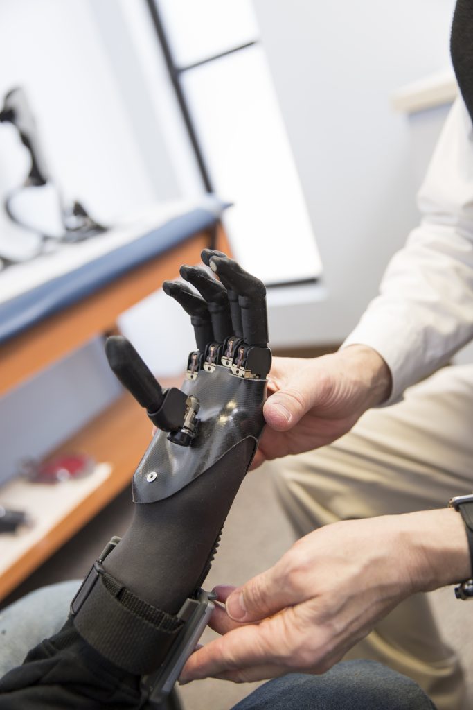 hand-prosthetic - Snell Prosthetics & Orthotics